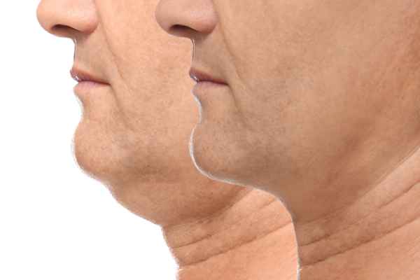 HIFU - Breakthrough in Anti - ageing 2 hifu results Wickford