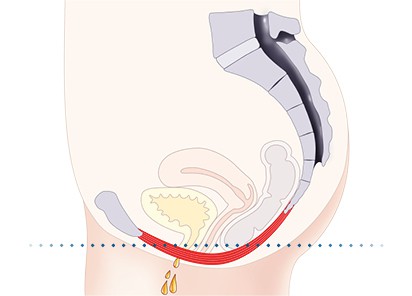 Pelvic-Floor Muscle Repair 5 Pelvic floor muscles Wickford