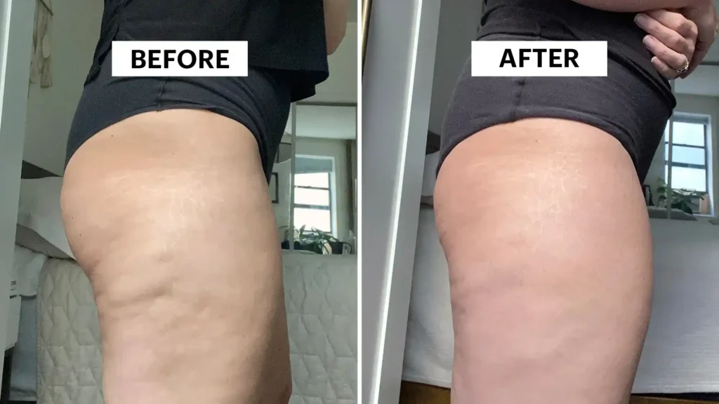 Do Toning Exercise Wickford Really Tackle Cellulite?