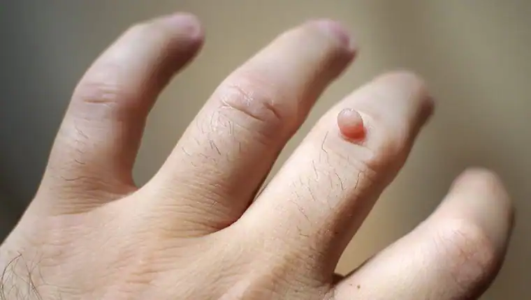 Cryotherapy For Warts And Also Verrucas 1 Image of blemish that Cryotherapy Wickford can remove with Lipo 360.