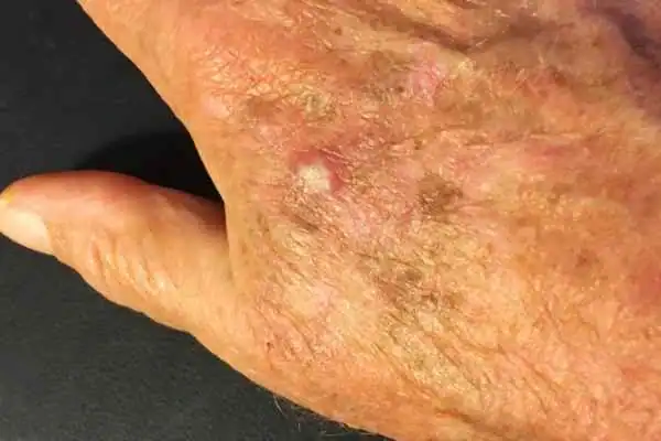 Cryopen For Actinic Keratoses 1 Image of Actinic keratoses Wickford on a person hand