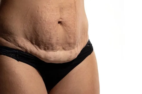 The Science of Skin Tightening 1 The science behind skin tightening Wickford picture of a woman's sagging skin on the stomach